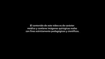 Trans-operatório da vaginoplastia mudança de sexo